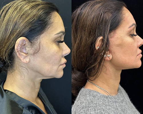 43-year-old Deep Plane Facelift postop Right Side View