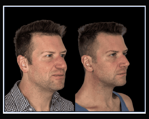 43-year-old Male Extended Deep Plane Necklift Photos NYC