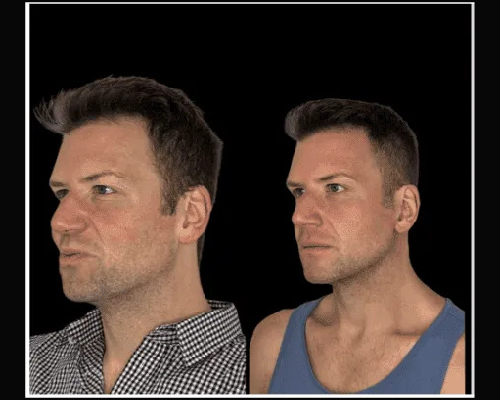 43-year-old Male Extended Deep Plane Neck Lift Photos