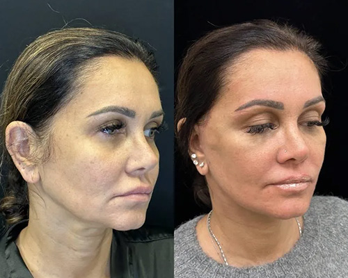 43-year-old Deep Plane Facelift postop Right Oblique View