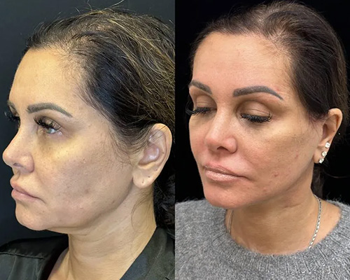 43-year-old Deep Plane Facelift postop Left Oblique View