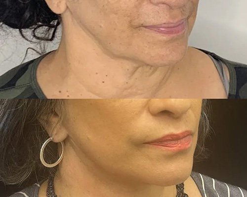 58-year-old female who underwent an Awake Deep Plane Facelift and necklift. 1