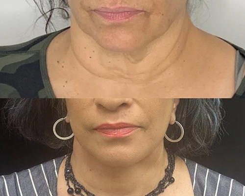 58-year-old female who underwent an Awake Deep Plane Facelift and necklift. 4