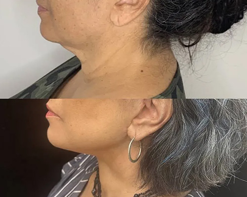 58-year-old female who underwent an Awake Deep Plane Facelift and necklift. 3