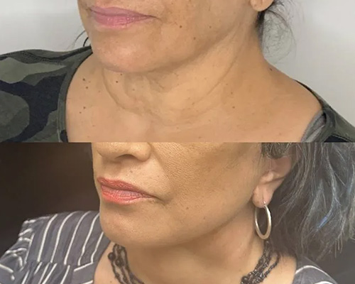 58-year-old female who underwent an Awake Deep Plane Facelift and necklift. 2