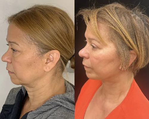 60-year-old female Deep Plane Facelift Left Side Photo