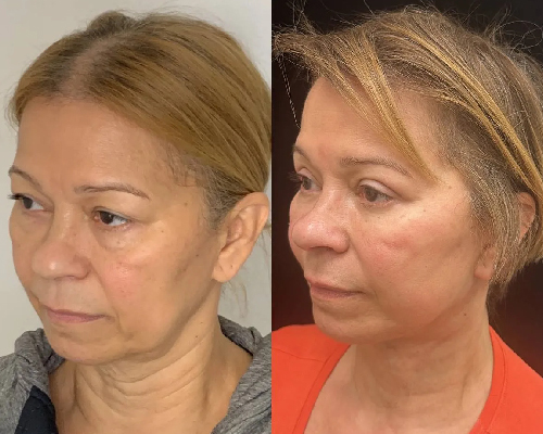 60-year-old female Deep Plane Facelift Left Oblique Photo