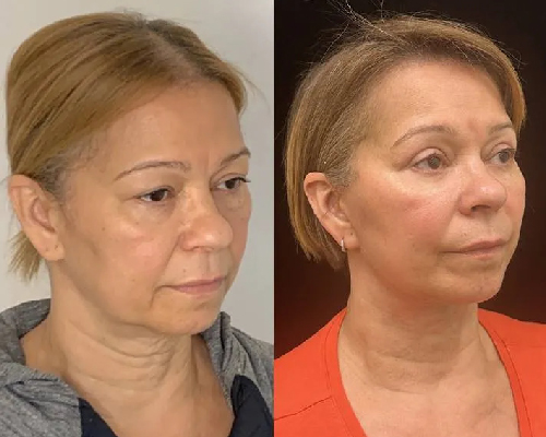 60-year-old female Deep Plane Facelift Right Oblique Photo