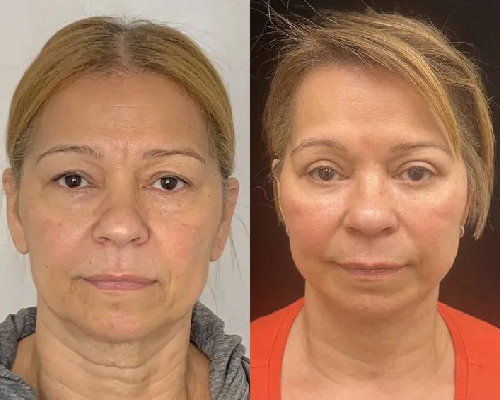 60-year-old female who underwent a Deep Plane Facelift, Necklift, Upper and Lower blepharoplasty