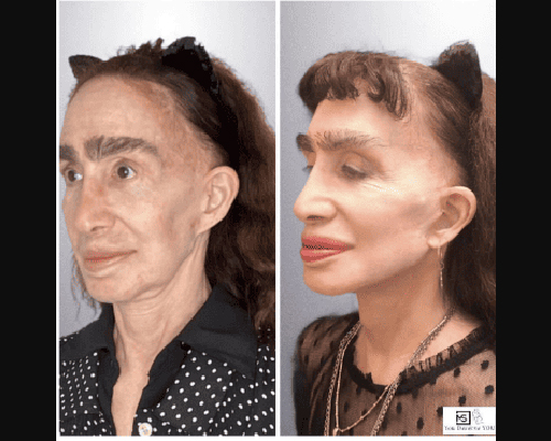 72-year-old Deep Plane Facelift Approach