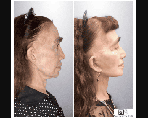 72-year-old Deep Plane Facelift Photos NYC