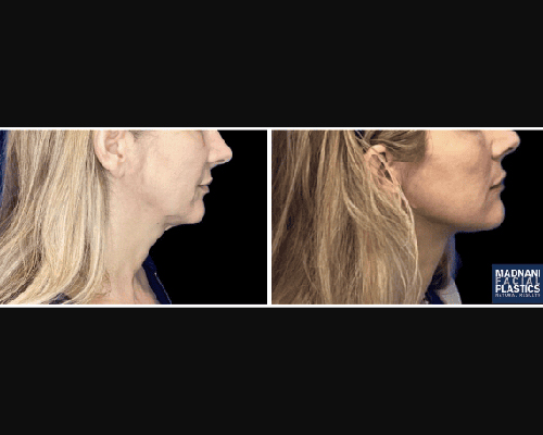 52-year-old Extended Deep Plane Facelift Patient Photos