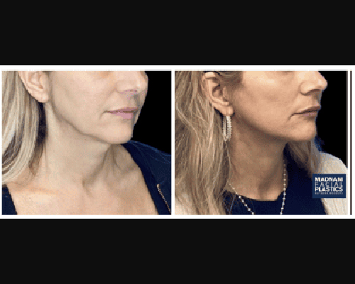 52-year-old Extended Deep Plane Facelift Patient