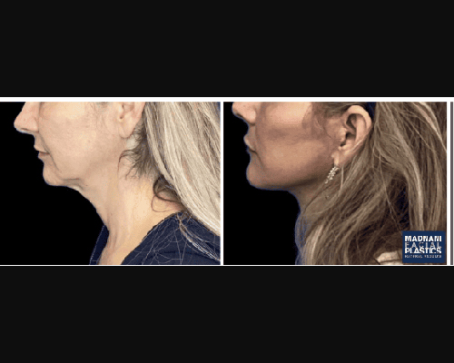 52-year-old Extended Deep Plane Facelift Before and After