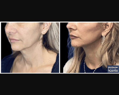 52-year-old Extended Deep Plane Facelift Patient results