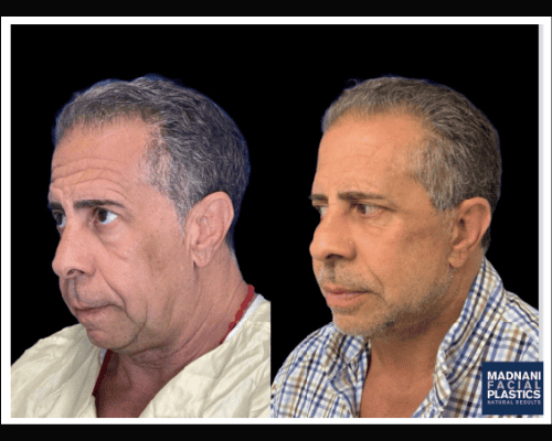 63-year-old Male Deep Plane Facelift Photos