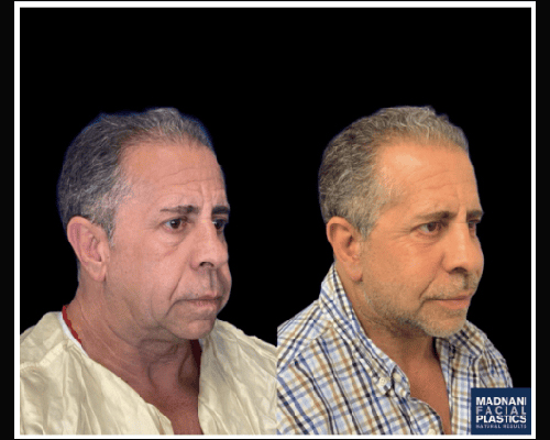 63-year-old Male Deep Plane Facelift Results NYC