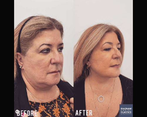 53-year-old Teacher Before and After Deep Plane Facelift