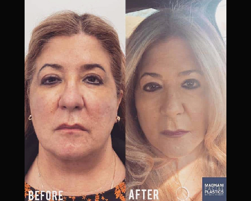 53-year-old Teacher After Deep Plane Facelift