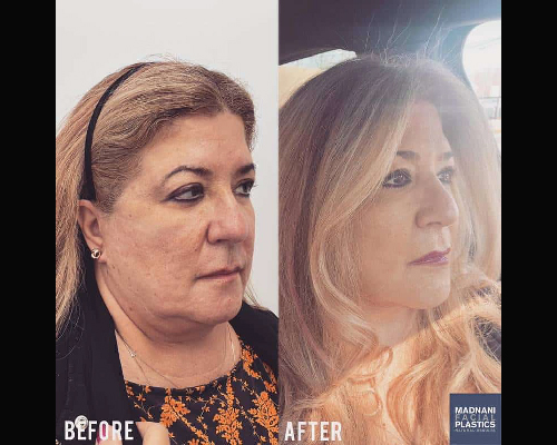 53-year-old Teacher Before and After Deep Plane Facelift NYC